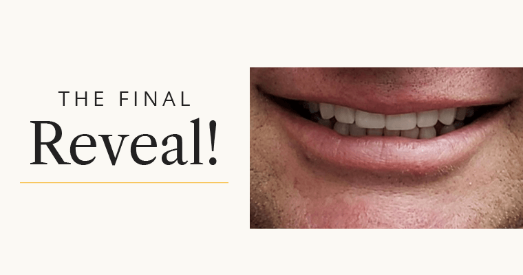Final reveal of Complete Smile Makeover
