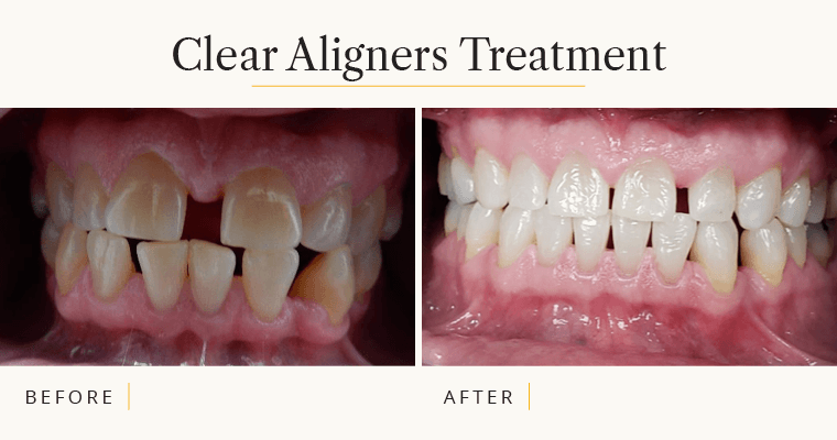 Open mouth showing teeth before treatment and after Clear Aligners