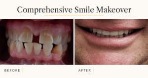 A before and after of a interdisciplinary approach to a smile makeover.