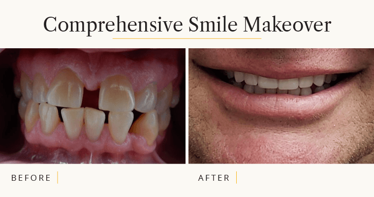 Smile Makeover – A Comprehensive Approach with Fantastic Results
