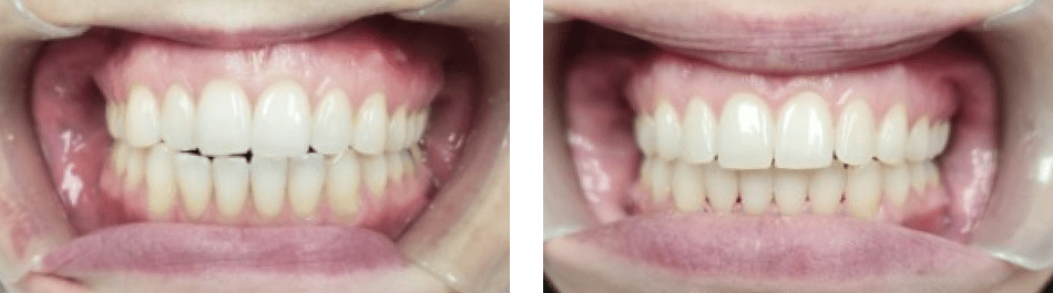 A closeup of patient's teeth before and after clear aligners