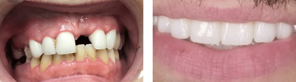 A closeup of patient's teeth before and after full mouth restoration
