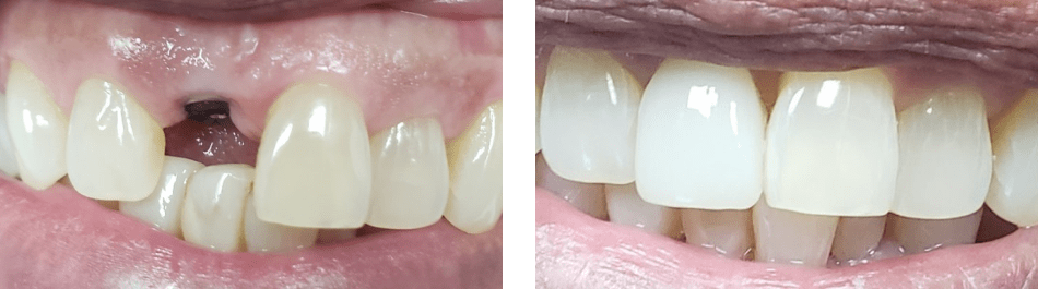 A closeup of patient's teeth before and after dental implants