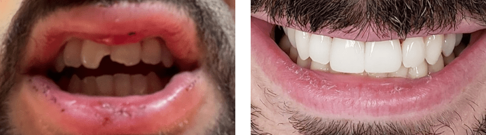 A closeup of patient's teeth before and after smile makeover