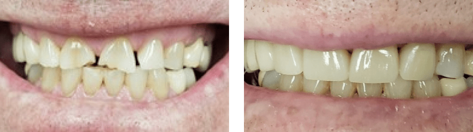 Closeups of a patient's smile before and after their Smile Design treatment at Elham Amini DDS