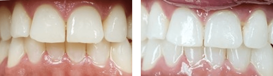A closeup of patient's teeth before and after teeth whitening
