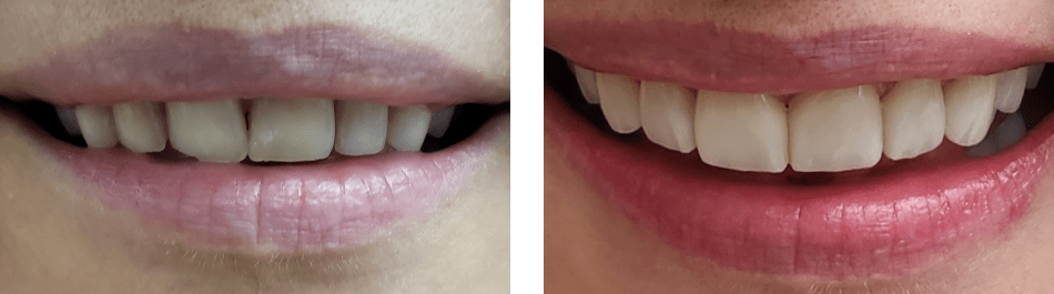A closeup of patient's teeth before and after veneers