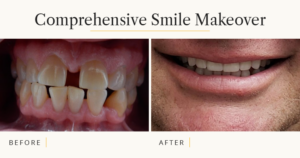 Closeups of a patient's smile before and after their Smile Makeover treatment